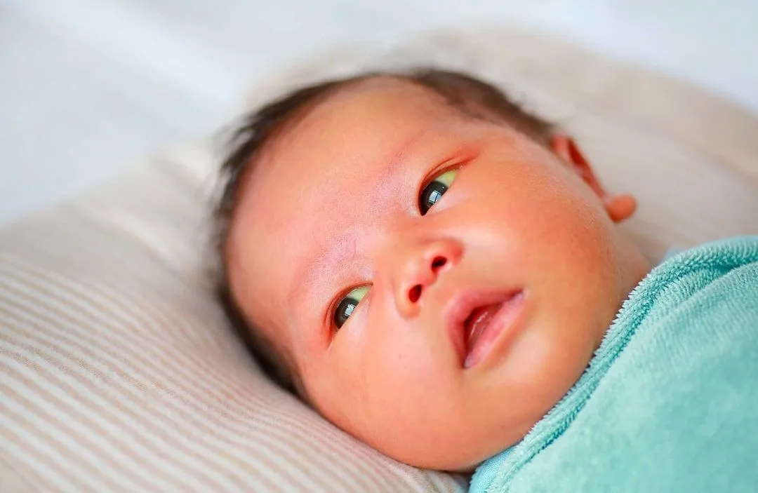 Icterícia Neonatal
